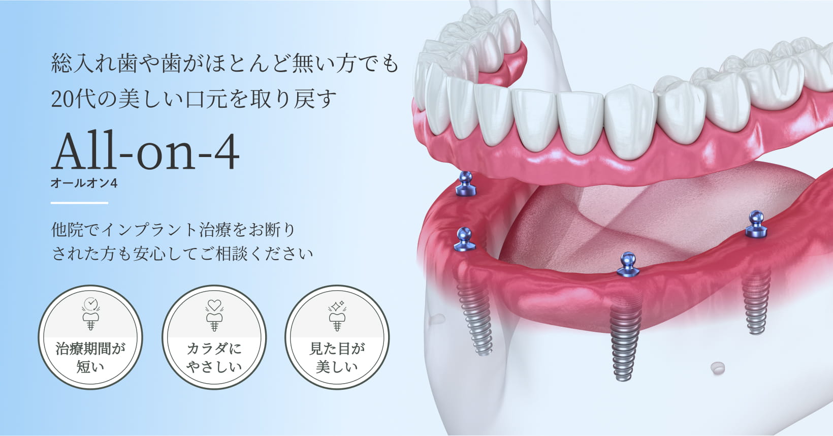 沖縄那覇のAllon4（オールオン4）専門サイト｜ナハデンタル