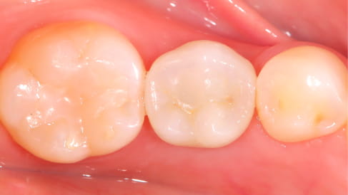 症例2：先天性欠如歯のインプラント治療[AFTER]