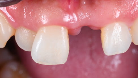 症例1：前歯のインプラント治療[BEFORE]