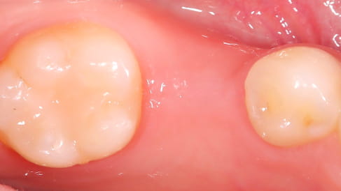 症例2：先天性欠如歯のインプラント治療[BEFORE]