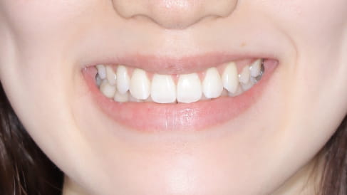 症例1：やえ歯と歯並びのガタつきの矯正治療[AFTER]