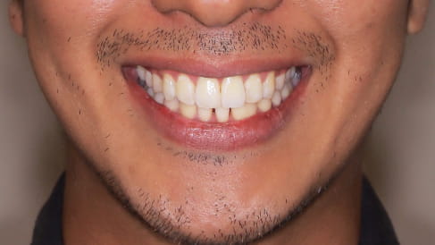 症例3：歯並びのがたつき、前歯の突出の矯正治療[AFTER]