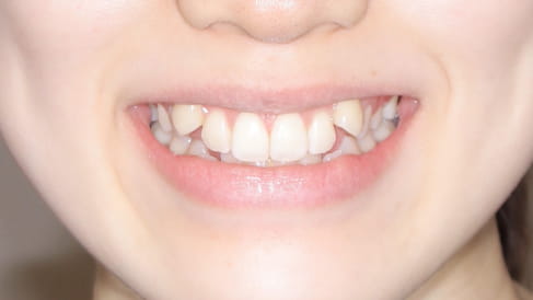 症例1：やえ歯と歯並びのガタつきの矯正治療[BEFORE]