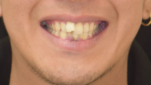症例3：歯並びのがたつき、前歯の突出の矯正治療[BEFORE]