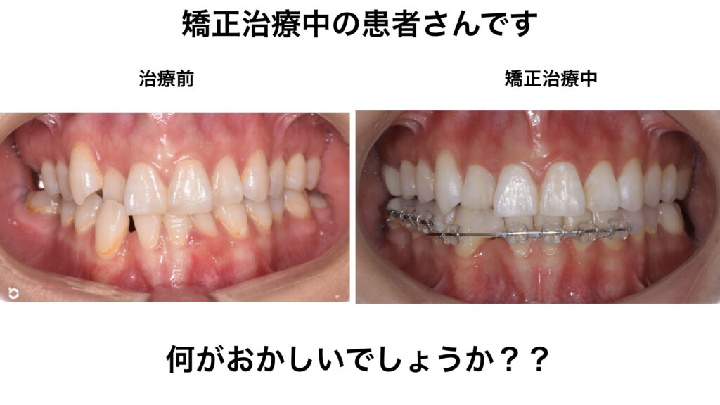 歯茎がさがって歯が長い はマイクロサージェリーで治します 那覇デンタルクリニック