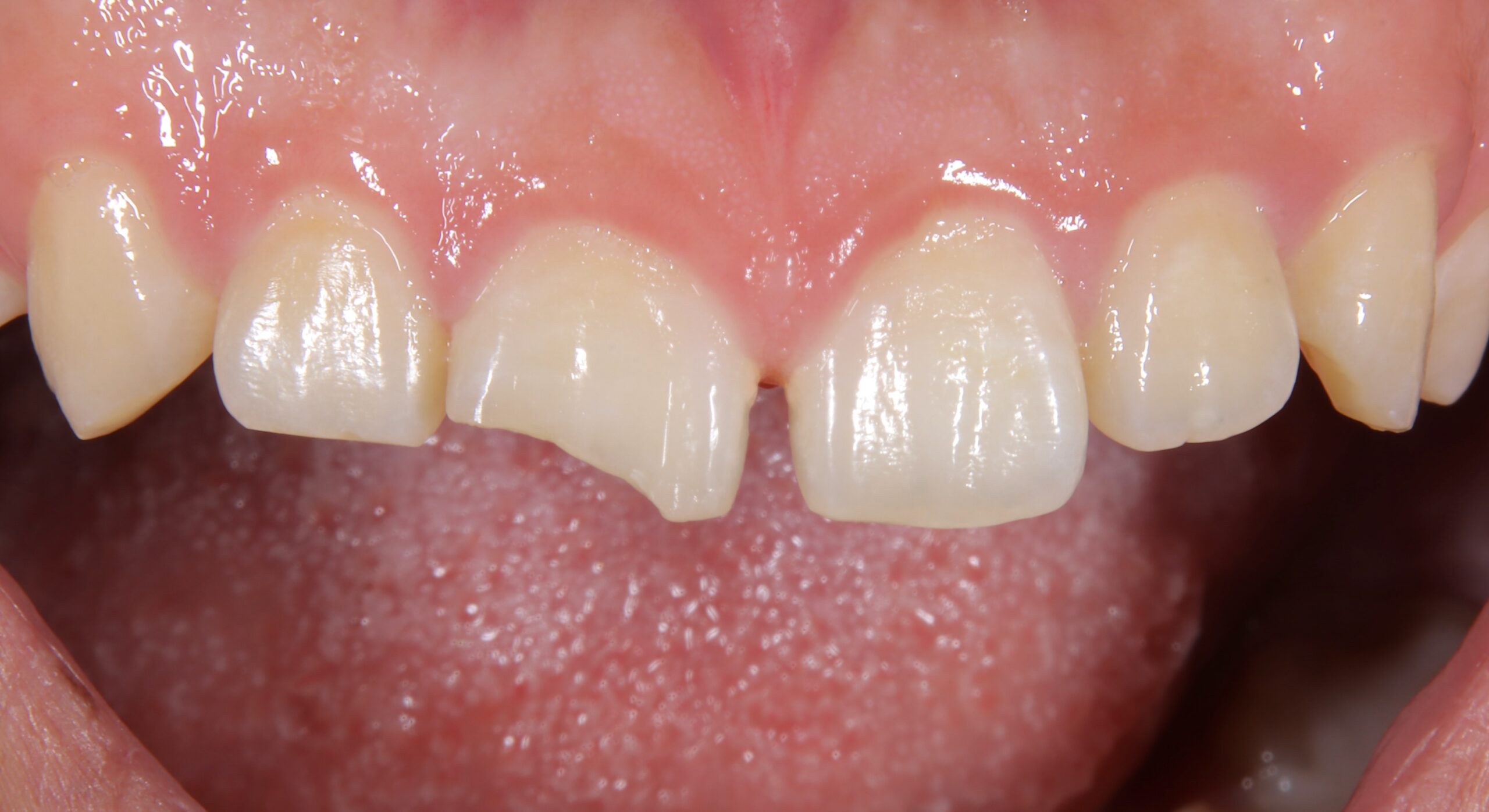 歯 が 欠け た 治療 前歯