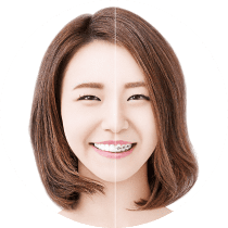 矯正装置をつけた女性