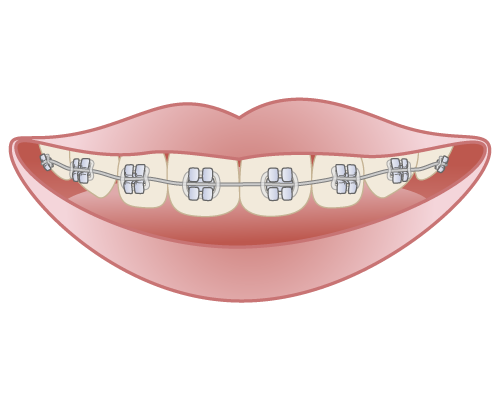 ワイヤーよりも治療期間は長くなりますか？