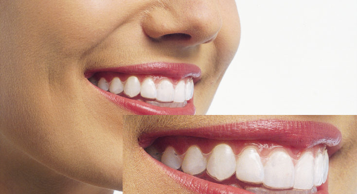 マウスピースは一日中装着しないといけないのですか？