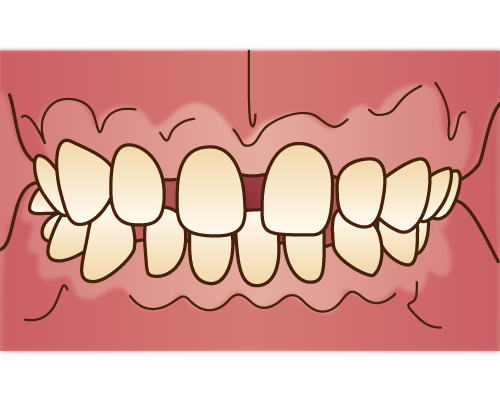 すきっ歯はインビザラインで治せますか？